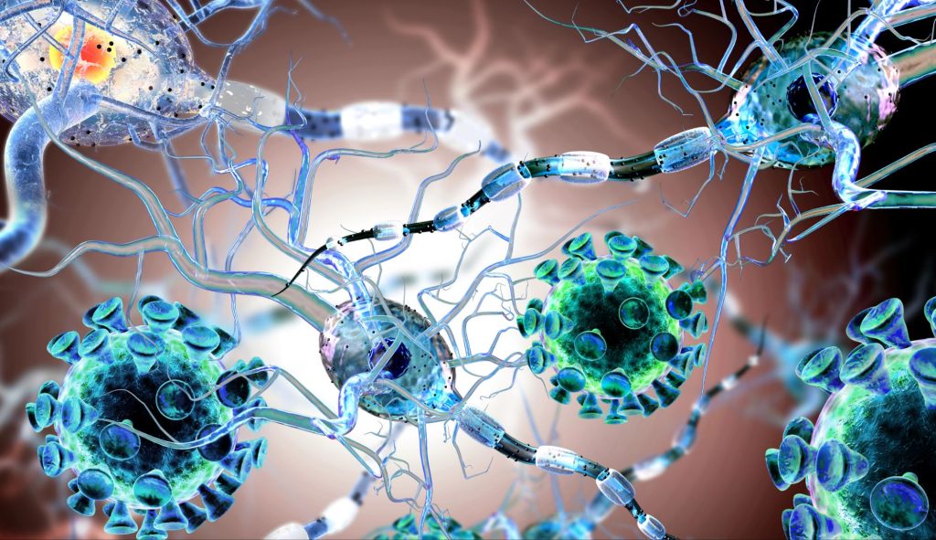 Huntington malattia AMT 130